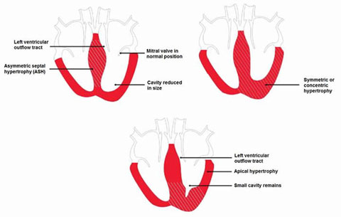 Hypertrophic Cardiomyopathy In British Shorthairs: Diagram