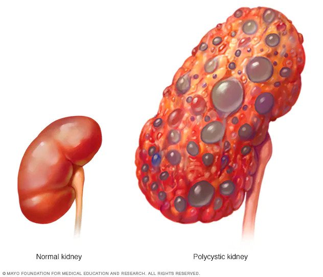 Polycystic Kidney Disease In British Shorthairs; PKD Kidney showing cysts